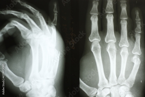 Surgical plates for osteosynthesis in case of bone fractures	 photo