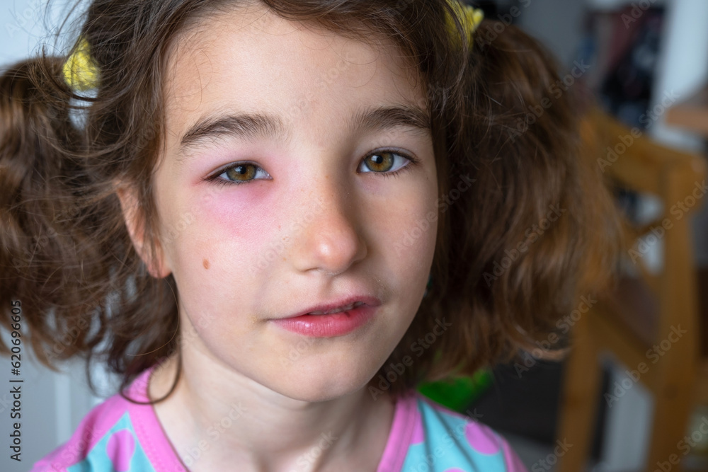 Foto de A red swollen eyelid on a child face in closeup is an allergy