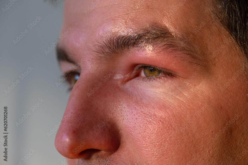 A red swollen eyelid on a man's face in close-up is an allergy to an insect bite. Allergic reaction to blood-sucking insects A red swollen eyelid on a man's face in close-up is an allergy to an insect bite. Allergic reaction to blood-sucking insects