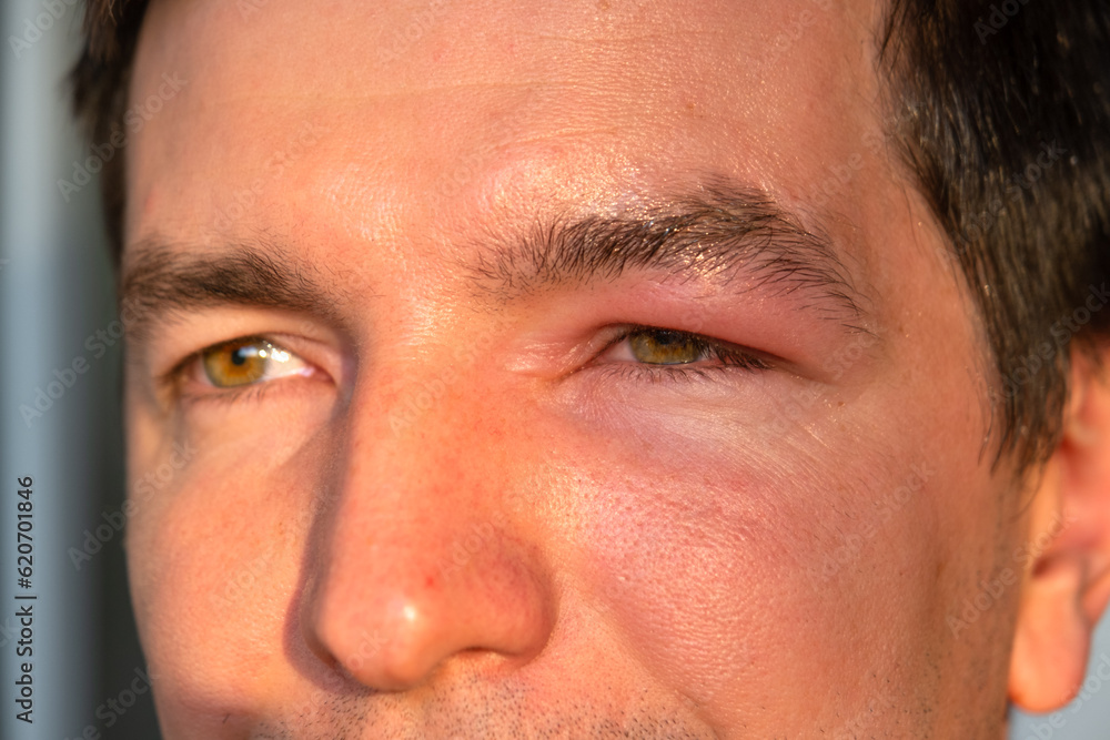 A red swollen eyelid on a man's face in close-up is an allergy to an insect bite. Allergic reaction to blood-sucking insects