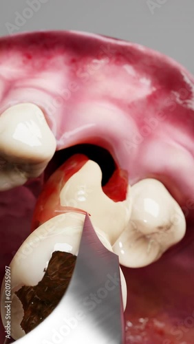 tooth extraction process photo