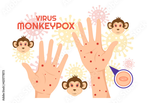 Monkey Pox Outbreak Vector Illustration of Virus Symptoms in Humans Monkeypox Microbiological in Flat Cartoon Hand Drawn Templates