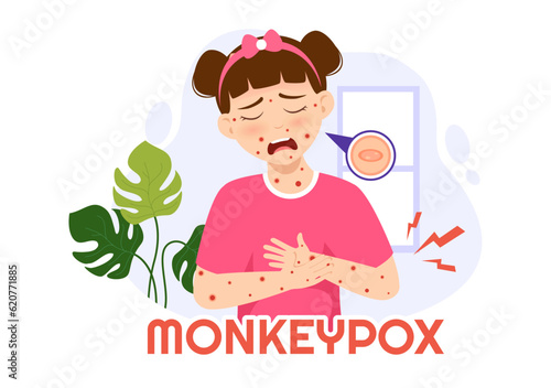 Monkey Pox Outbreak Vector Illustration of Virus Symptoms in Humans Monkeypox Microbiological in Flat Cartoon Hand Drawn Templates