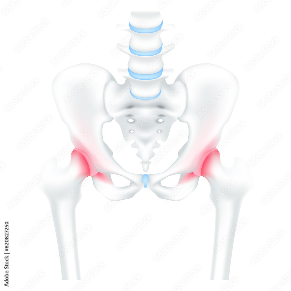 Hip bone, pelvis and joint arthritis hip pain cartilage worn. Human