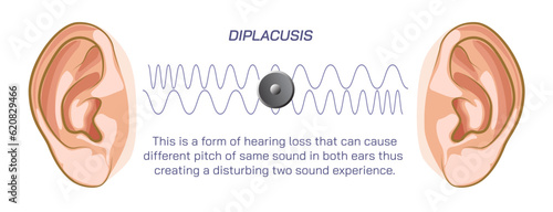 Difference between two ears, double hearing, density or pressure of sound, different frequency, compression, rarefaction and ambient pressure. travelling sound wave, Dysharmonica and echoica. sound