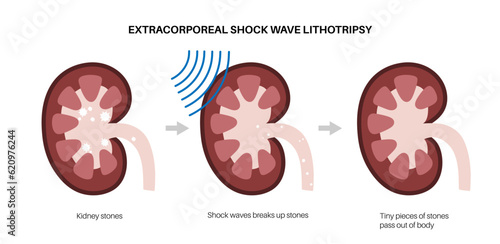 Lithotripsy procedure concept