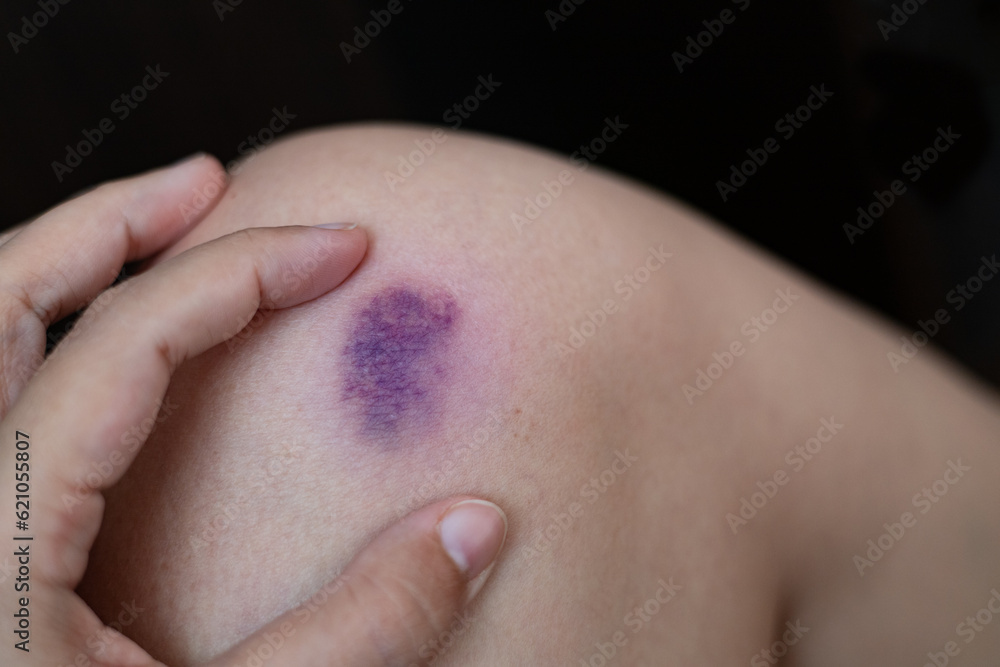 Naklejka premium Purple bruise on the knee skin