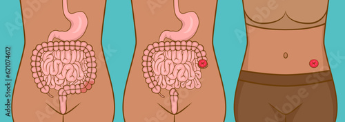 Woman with stoma after colon cancer surgery
