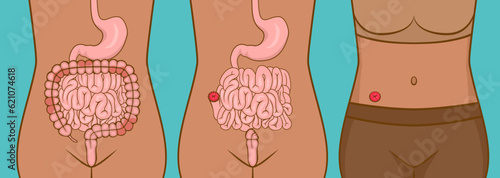 Woman with ileostomy after rectal surgery