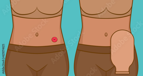 Woman with stoma and colostomy bag photo