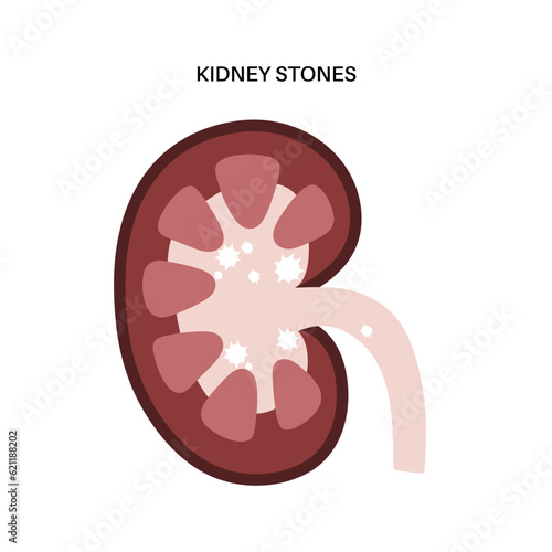 Kidney stones treatment