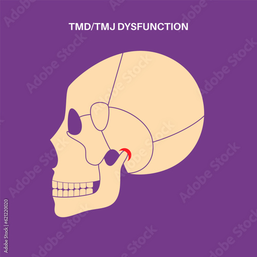 TMD TMJ disorder