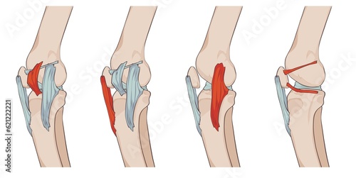 knee ligaments and menisci, with medial patellar retinaculum, medial patellofemoral ligament, patellomemiscal ligament, tibial collateral ligament and patellar ligament, jpg photo