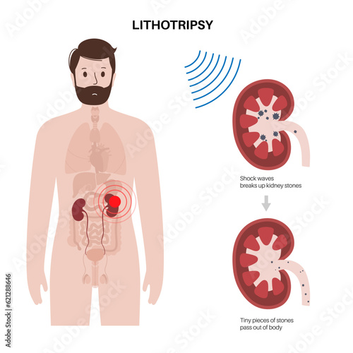 Lithotripsy procedure concept