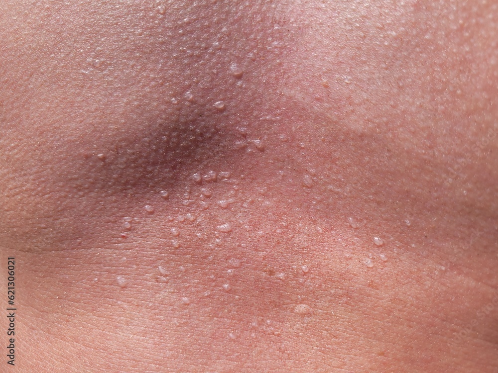 Fototapeta premium Sunburn on the skin with blisters. Sunburn is the result of prolonged exposure to the sun without sunscreen or lotion