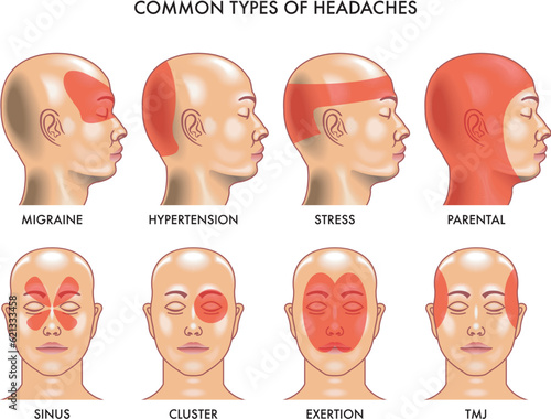 Medical Illustration of common types of headaches.