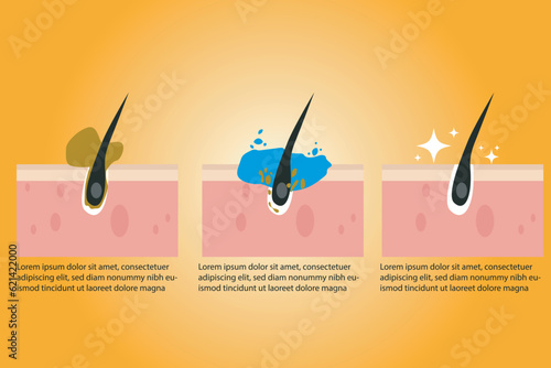 Cleaning blackheads process flat illustration. Clogged pores removal, skin cleaning foam, skincare vector illustration