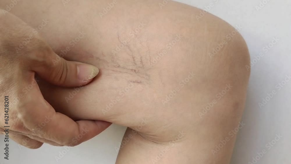 close up the fingers holding the varicose veins, problem wrinkles and flabby skin on the leg of the woman, health care and beauty concept. close up the fingers holding the varicose veins, problem wrinkles and flabby skin on the leg of the woman, health care and beauty concept.