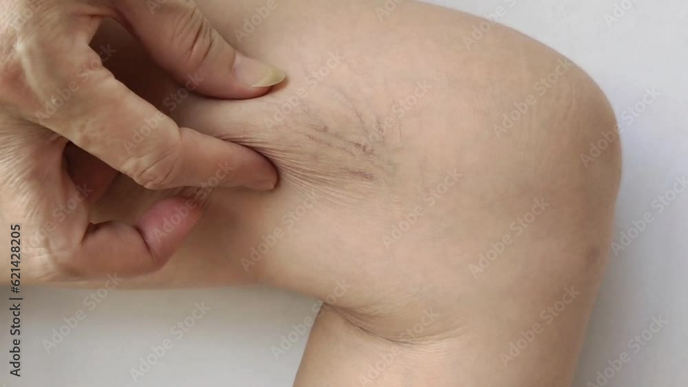 portrait showing the fingers holding varicose veins on the leg of the woman, Wrinkles and Flabby skin, problem circulation of blood, health care and medical concept. portrait showing the fingers holding varicose veins on the leg of the woman, Wrinkles and Flabby skin, problem circulation of blood, health care and medical concept.