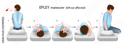 Epley maneuver left ear affected vector illustration photo