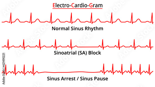 Set of ECG Common Abnormalities - Sinoatrial (SA) Block - Sinus Arrest / Sinus Pause - Electrocardiography Vector Medical Illustration