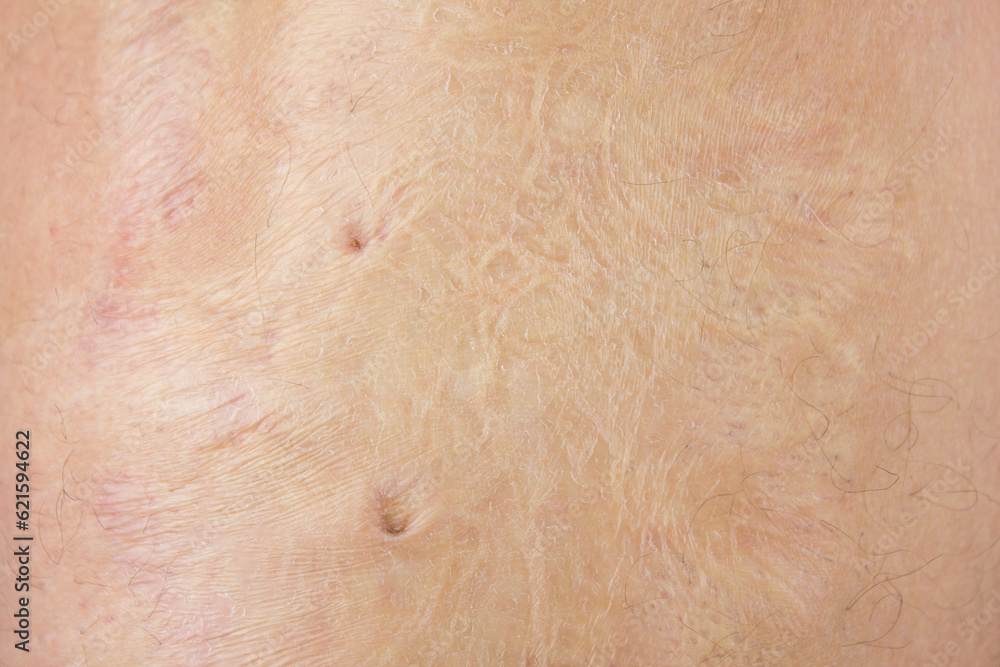 Fototapeta premium Burn scars, burn scars on the body. Consequences of burns.