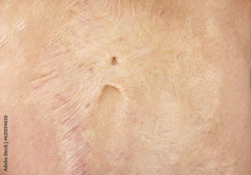 Fototapeta premium Burn scars, burn scars on the body. Consequences of burns.