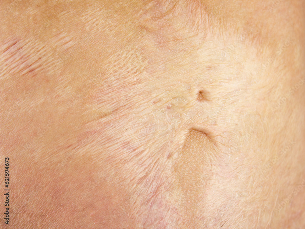 Fototapeta premium Burn scars, burn scars on the body. Consequences of burns.