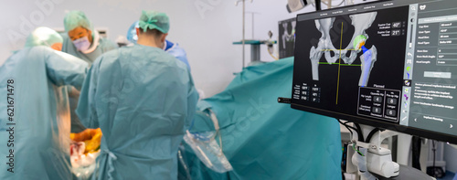 Team of doctor perform total hip arthroplasty replacement surgery in osteoarthritis patient inside the operating room. robot-assisted - robotic hip and knee replacement surgery