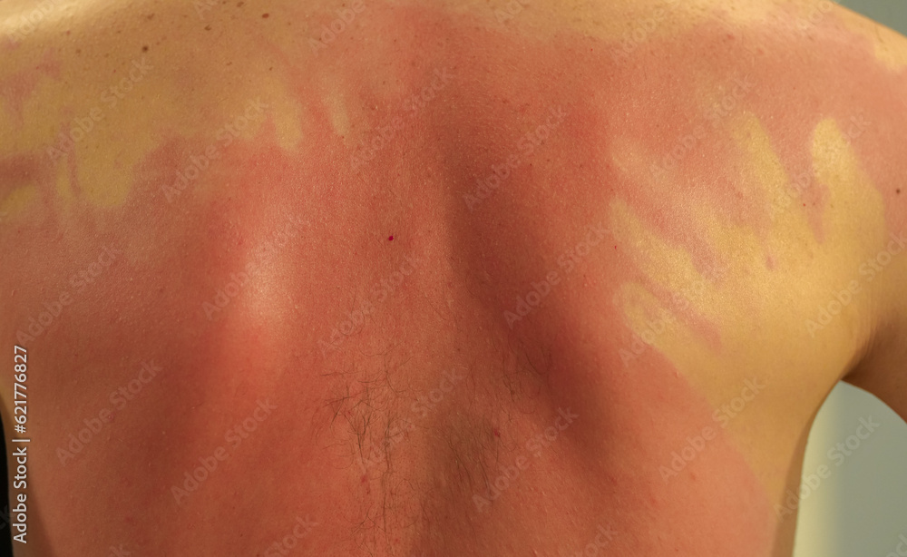 Fototapeta premium Sunburn on the back of a man. Burnt skin because of standing in the sun without protection. Hands marks on the place where sun UV protection lotion has been used.