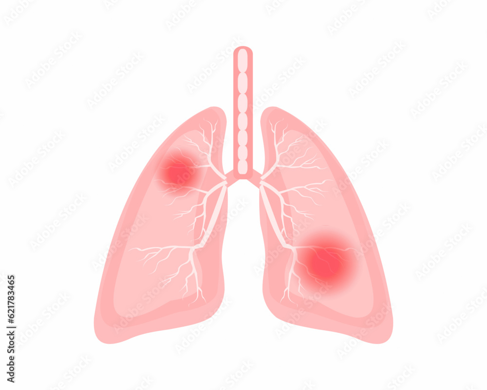 Chest discomfort Pain in the lungs human body lungs anatomy. Chest discomfort Pain in the lungs human body lungs anatomy.