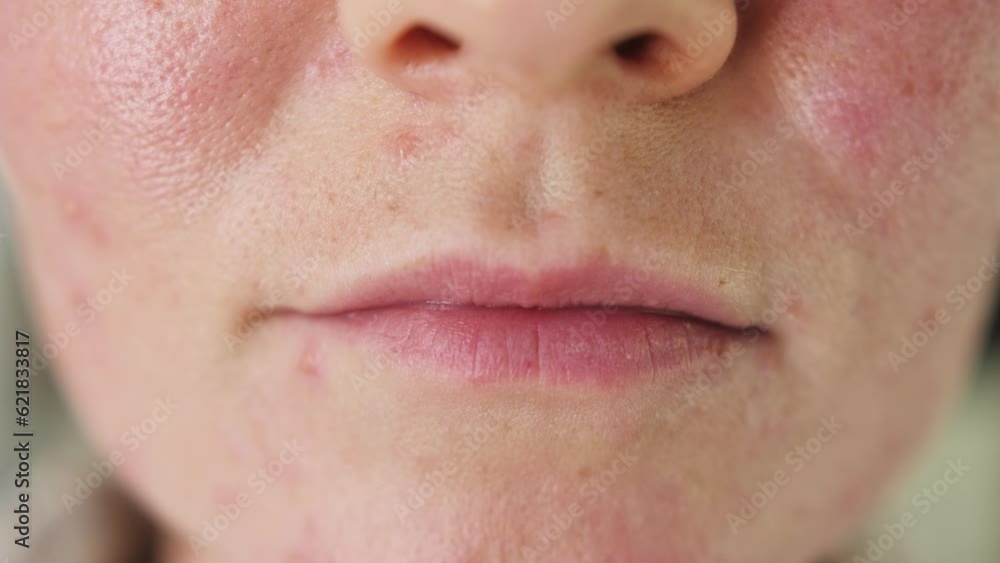 Close up of skin problems, unhealthy skin with acne and pimples. Porous, demodex and rosacea, red rashes. The concept of care for problem skin. Allergic and redness. Close up of skin problems, unhealthy skin with acne and pimples. Porous, demodex and rosacea, red rashes. The concept of care for problem skin. Allergic and redness.