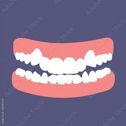 Orthodontic teeth problem crowding. Abnormal eruption. Double tooth. Opposite occlusion, open bite, crowded teeth, cavities, dentition. Vector illustration