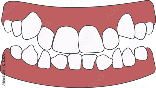 Orthodontic problem teeth crowding. Abnormal eruption. Opposite occlusion, open bite, crowded teeth, cavities, dentition. Vector illustration isolated