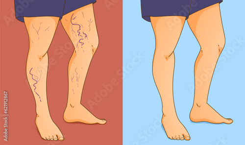 Human body with health problems. Varicose veins. Before, after. Vector illustration. Healthcare illustration.  photo