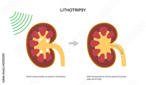 Lithotripsy procedure concept