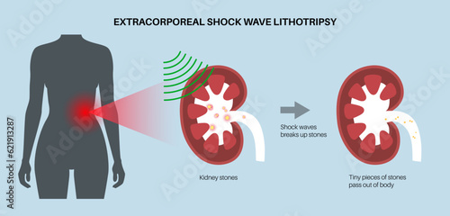 Lithotripsy procedure concept