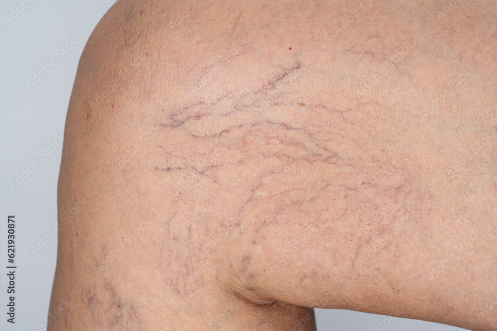 Fototapeta premium Varicose veins on female leg