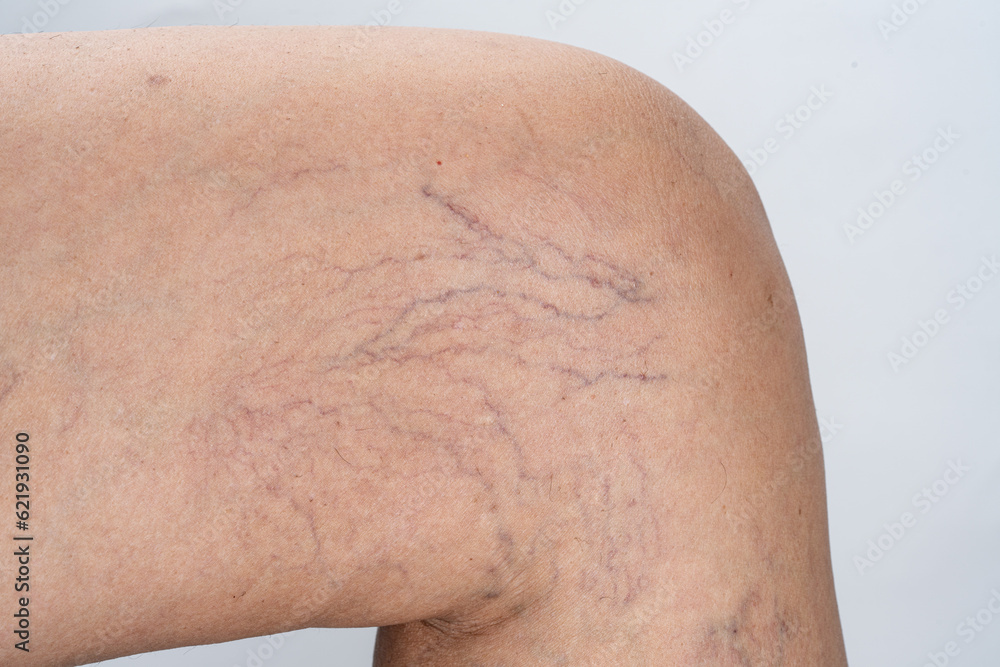 Fototapeta premium Varicose veins on female leg