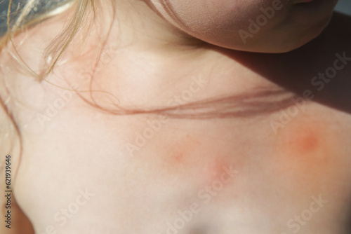 Little girl has skin rash from allergy or mosquito bites 