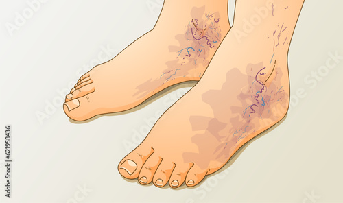 Human legs with health problems. Bruise, hematoma. Varicose veins. Vector illustration. Healthcare illustration.