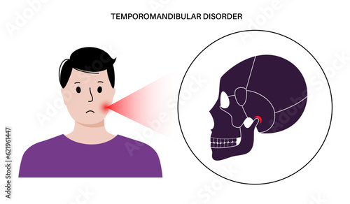 TMD TMJ disorder