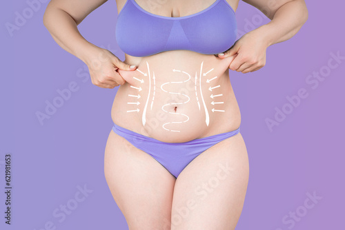 Abdomen liposuction, fat and cellulite removal concept, overweight female body with painted surgical lines and arrows