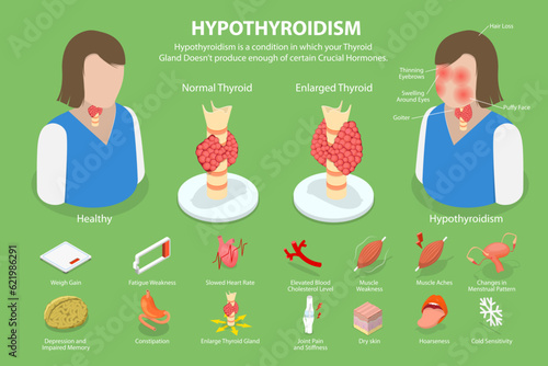 3D Isometric Flat Vector Conceptual Illustration of Hypothyroidism, Thyroid Gland Disease