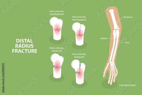 Photographie 3D Isometric Flat Vector Conceptual Illustration of Distal Radius Fracture, Labe