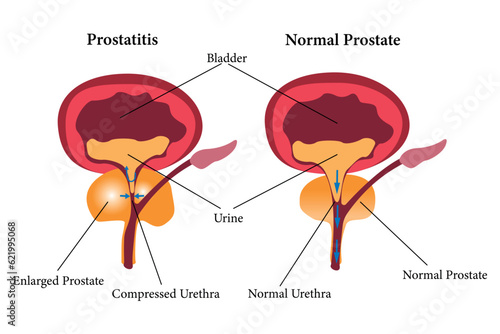 comparation of health prostate and unhealth prostate. prostatitis illustration icon set on white bacground. eps 10 photo