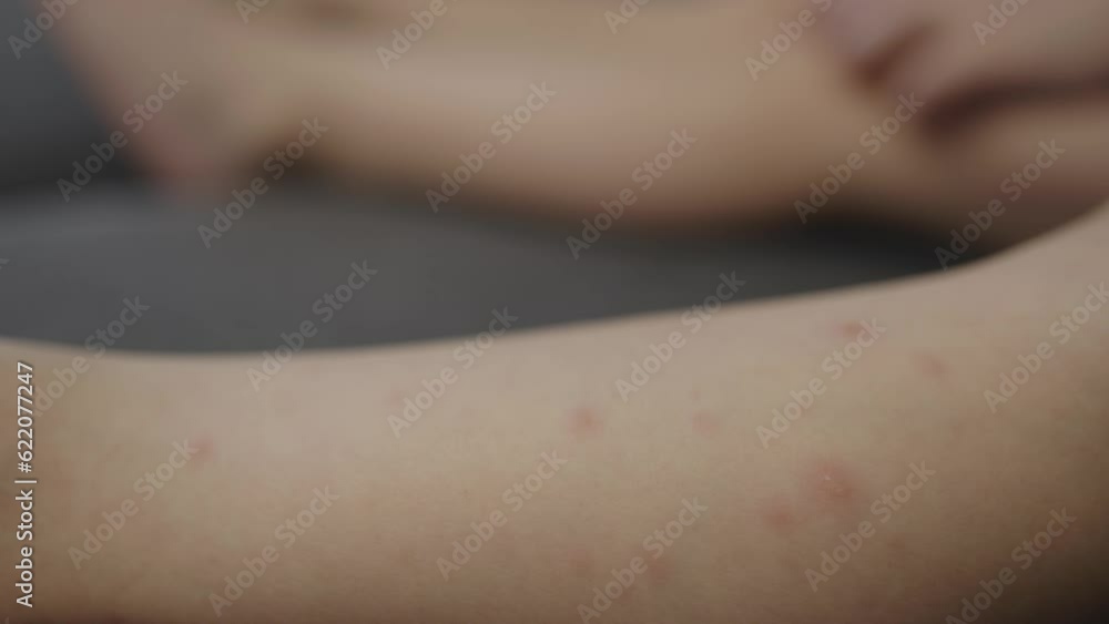 viral disease childhood illness chicken pox pimples symptoms on child's