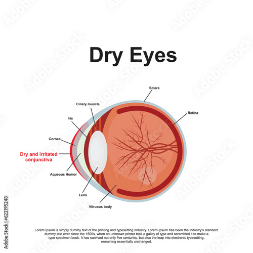 Dry Eyes Anatomy Vector Illustration