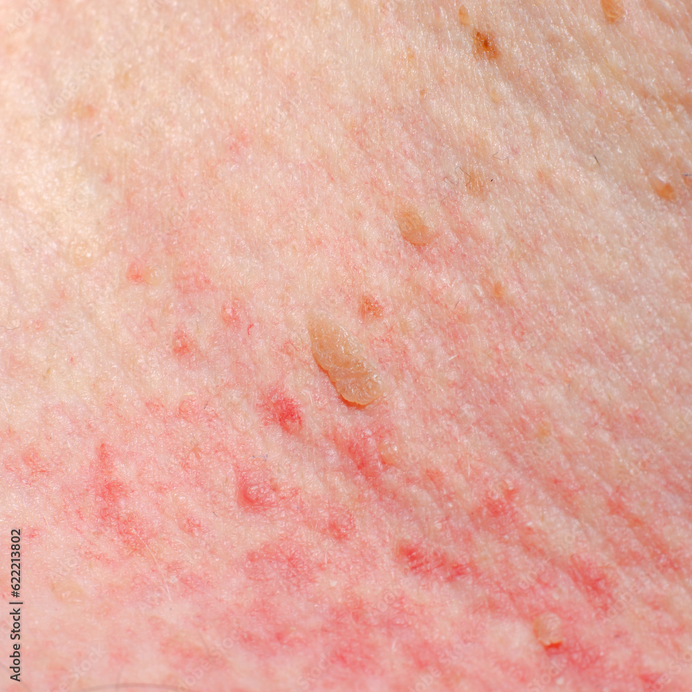 Fototapeta premium Keratosis or papilloma on the skin of an adult. Irritation or allergic reaction.