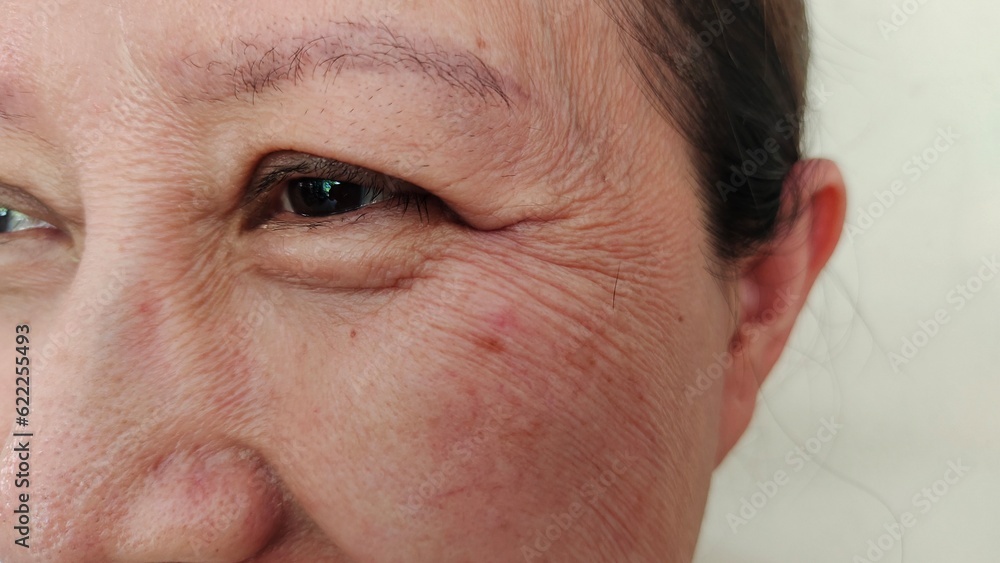 close up the blemish and freckles, ptosis and flabby skin beside the eyelid, dark spots and scar on the cheek of a woman, health care and beauty concept. close up the blemish and freckles, ptosis and flabby skin beside the eyelid, dark spots and scar on the cheek of a woman, health care and beauty concept.